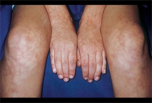 Hands and knees display discoloration patches on the skin, suggesting a chronic condition requiring careful management with coping skills for chronic pain.